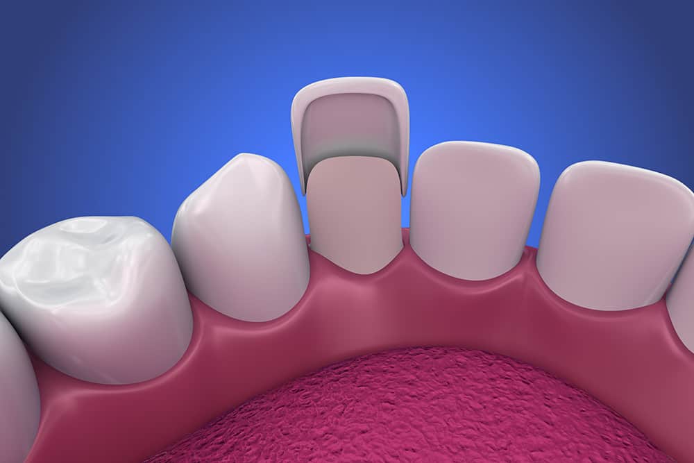 A 3D rendering of porcelain veneers being installed in a mouth.