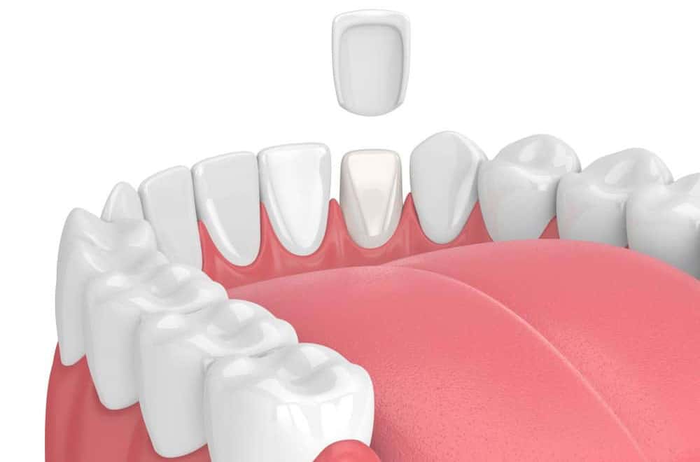 Illustration of how porcelain veneer overlays a tooth