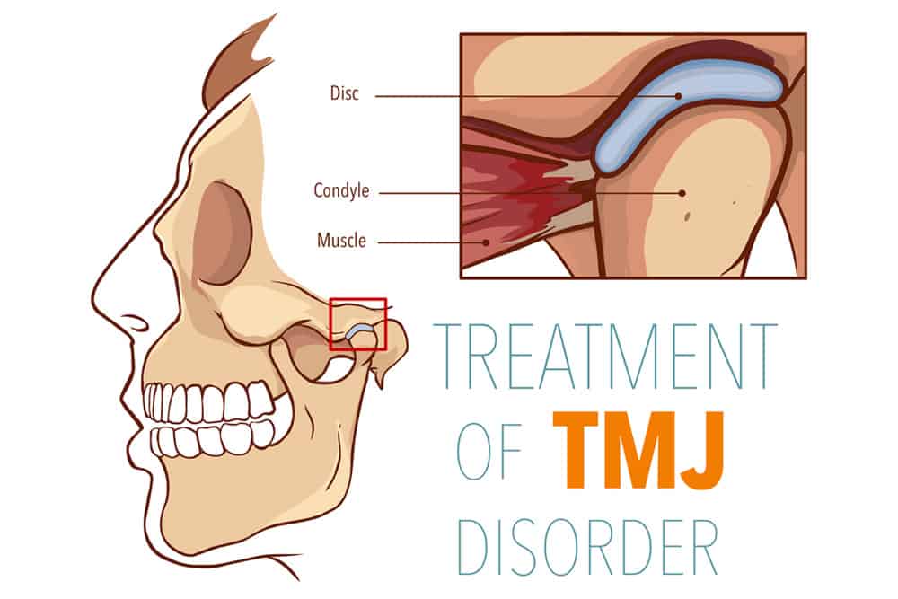 This is a diagram of a human skull that highlights the Temporomandibular Joint.