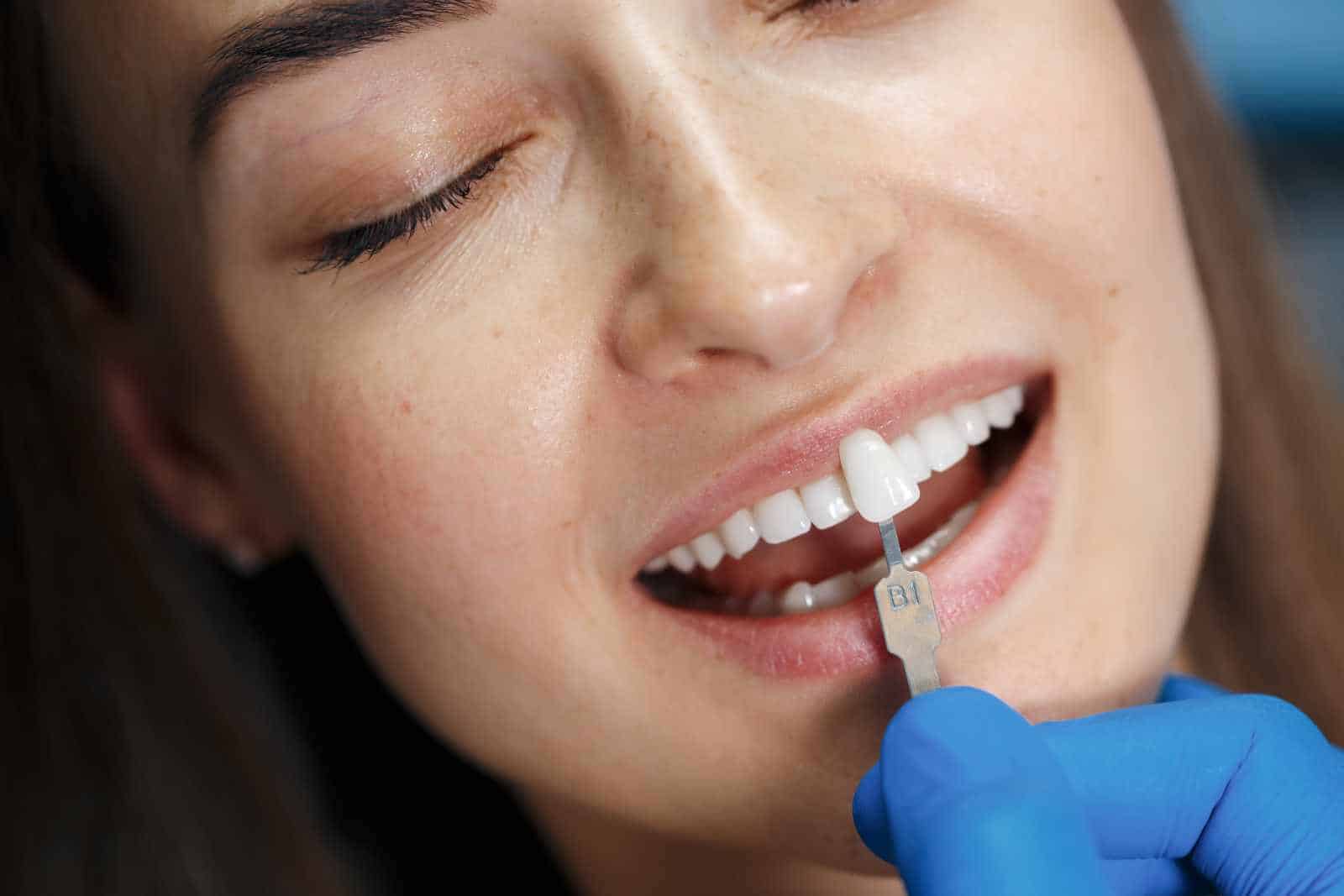 Thin porcelain veneer shell held on a fingertip, comparing Lumineers vs traditional veneers